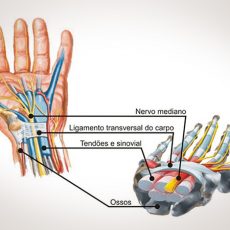 Síndrome do Túnel do Carpo